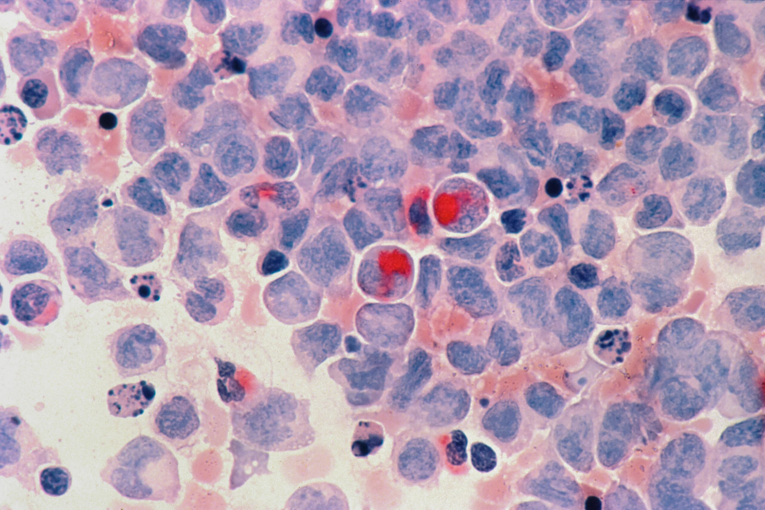 Conquering Chronic Myeloid Leukemia